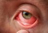 How Long Is Pink Eye Contagious How Long Is Pink Eye Contagious