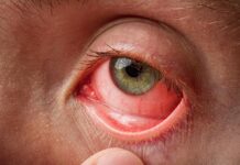 How Long Is Pink Eye Contagious How Long Is Pink Eye Contagious
