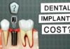 How Much Are Dental Implants How Much Are Dental Implants