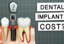 How Much Are Dental Implants How Much Are Dental Implants