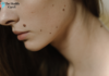 What Causes Skin Tags on Neck? Understanding Causes What Causes Skin Tags on Neck?
