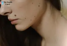 What Causes Skin Tags on Neck? Understanding Causes What Causes Skin Tags on Neck?