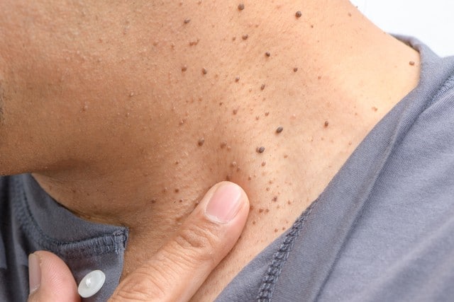 Causes of Skin Tags on Neck