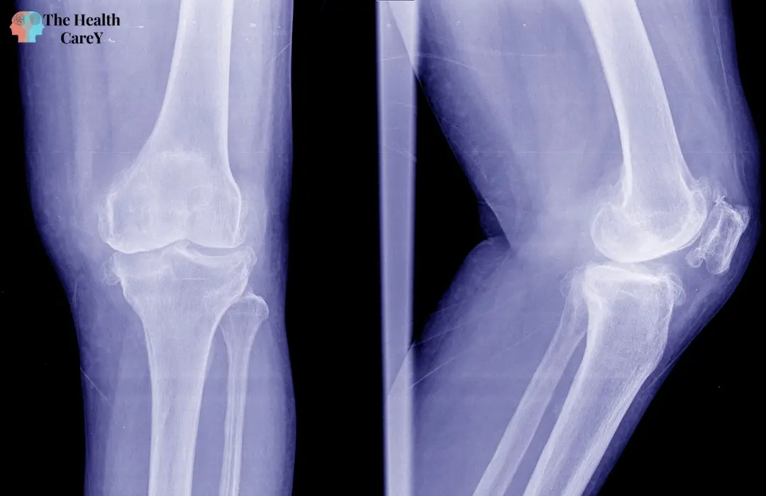 How to Dissolve Bone Spurs Naturally?