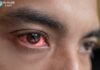 What is Commonly Misdiagnosed as Pink Eye What is commonly misdiagnosed as pink eye: A guide to identifying similar eye conditions