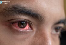 What is Commonly Misdiagnosed as Pink Eye What is commonly misdiagnosed as pink eye: A guide to identifying similar eye conditions