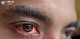 What is commonly misdiagnosed as pink eye: A guide to identifying similar eye conditions