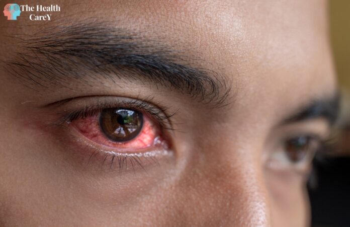 What is commonly misdiagnosed as pink eye: A guide to identifying similar eye conditions