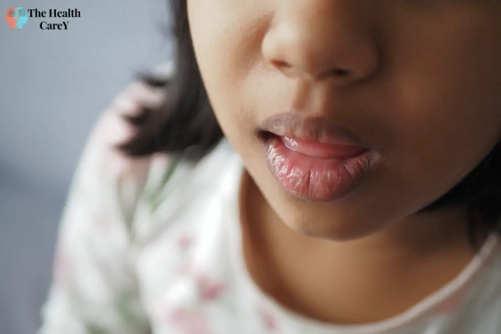 How to Heal Cracked Lip Corners Fast? The Health Carey