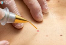 How to Get Rid of Cherry Angiomas at Home: Effective Home Remedies How to Get Rid of Cherry Angiomas at Home: Effective Home Remedies