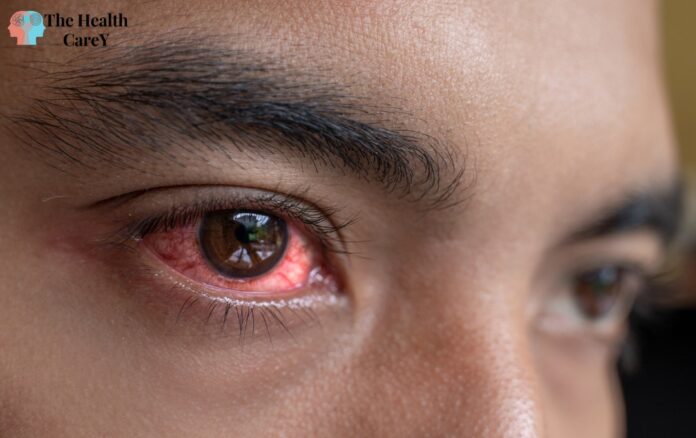 Can You Get Pink Eye from a Fart? Exploring the Possibility